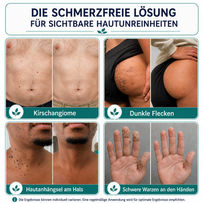 🆙🌿 Botanische Mikronadel-Pflaster zur gezielten Entfernung von Hautanhängseln