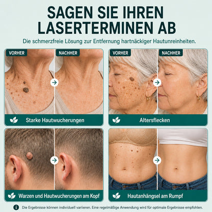 🆙🌿 Botanische Mikronadel-Pflaster zur gezielten Entfernung von Hautanhängseln