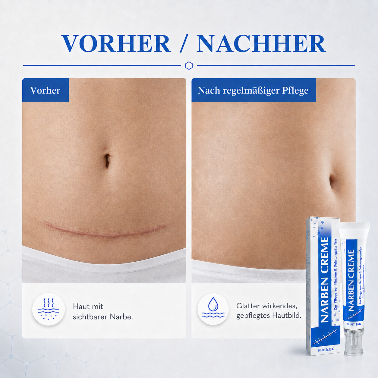 Kalovino® Reparierende Narbenpflege-Creme gegen Dehnungsstreifen, Aknenarben & unebenes Hautbild – für glatter und ebenmäßiger wirkende Haut