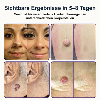 🌿 Kalovino® Effektive botanische Mikronadel-Pflaster zur gezielten Pflege kleiner Hautanhängsel