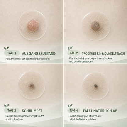 🌿 Kalovino® Effektive botanische Mikronadel-Pflaster zur gezielten Pflege kleiner Hautanhängsel